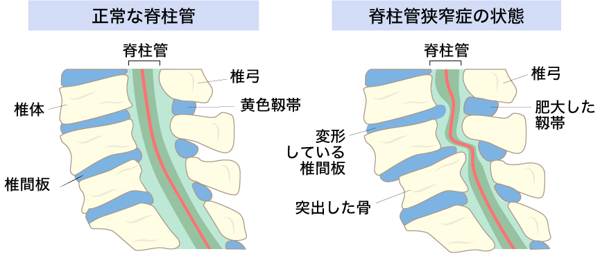 脊柱管狭窄症とはどんな状態？